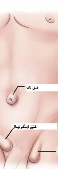 Testicular-hernia-photo-