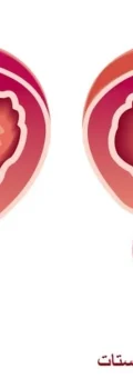 prostate1
