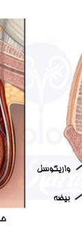 urologykarami-varicocele